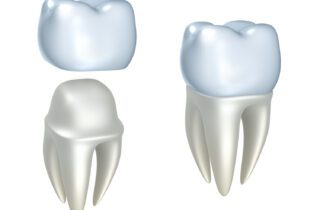 Understanding the situations that necessitate a dental crown can help you make informed decisions about your oral health.